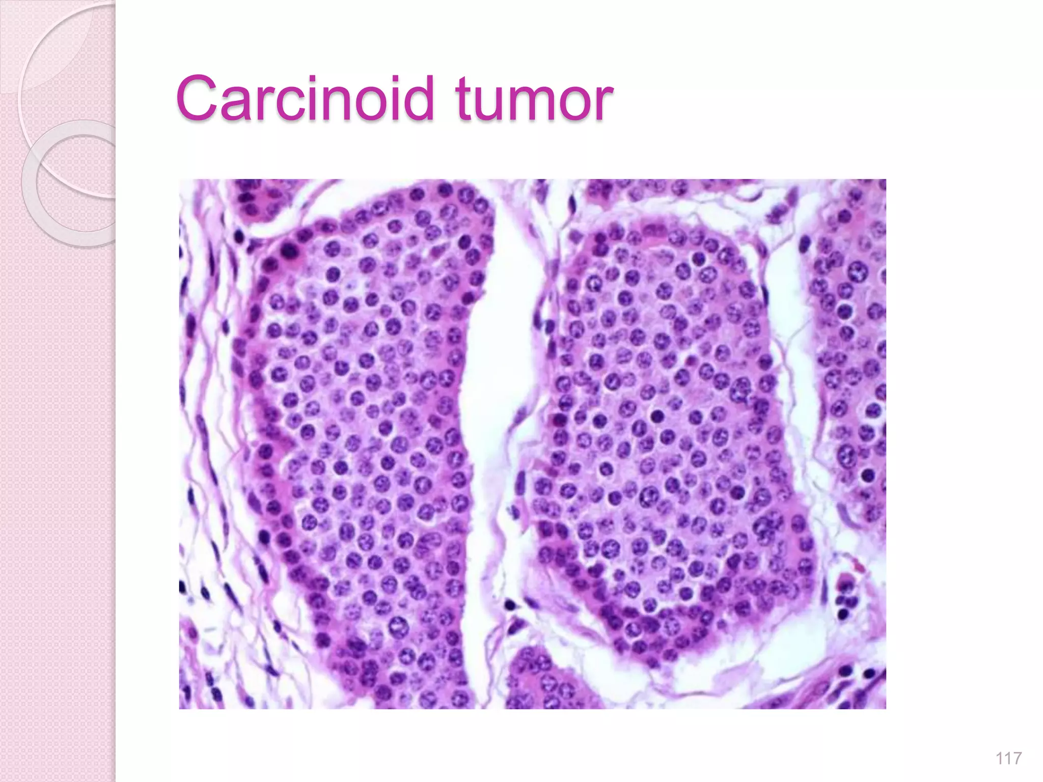 Carcinoid tumor
117
 