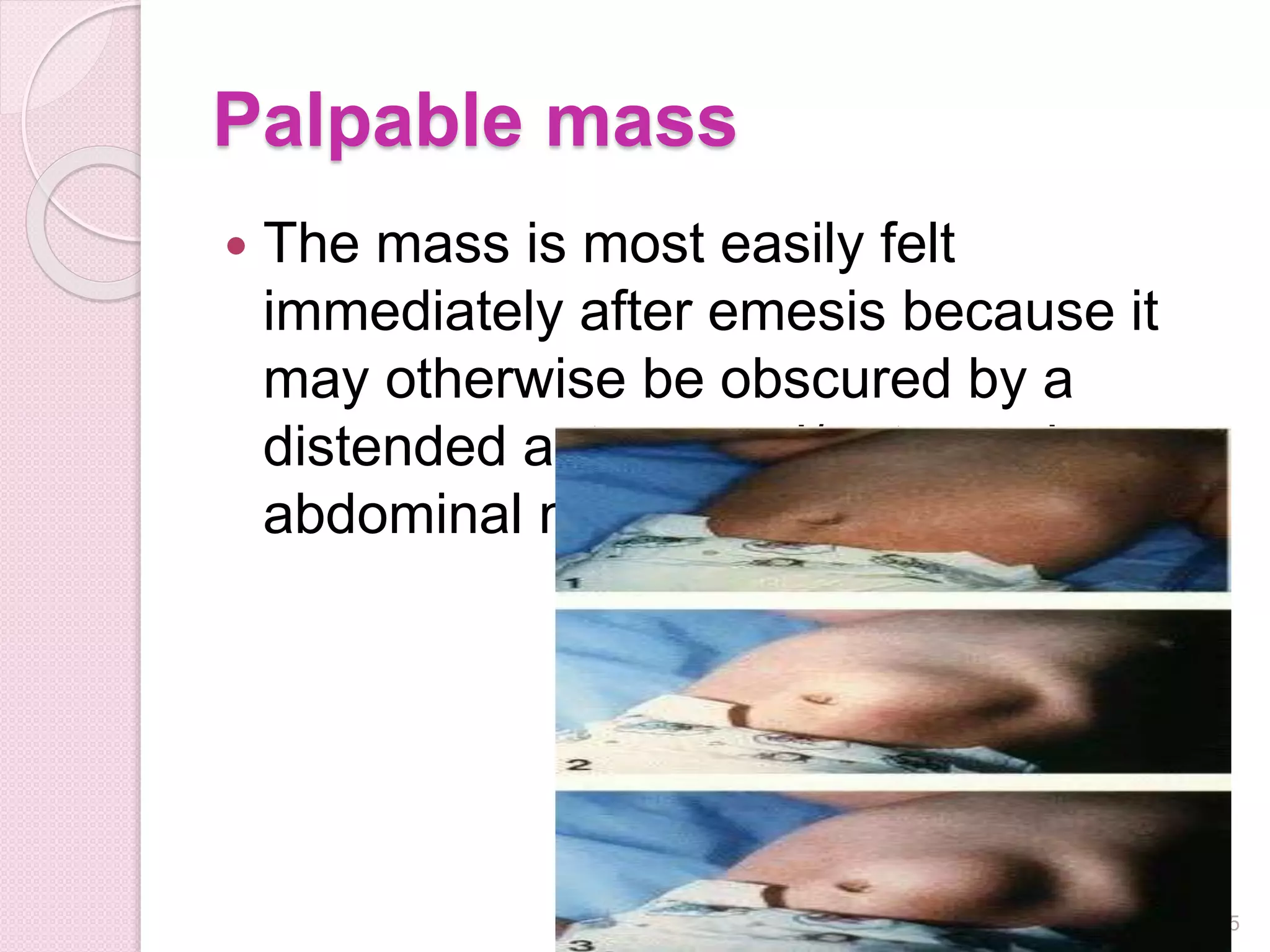 Palpable mass
 The mass is most easily felt
immediately after emesis because it
may otherwise be obscured by a
distended antrum and/or tensed
abdominal muscles
15
 
