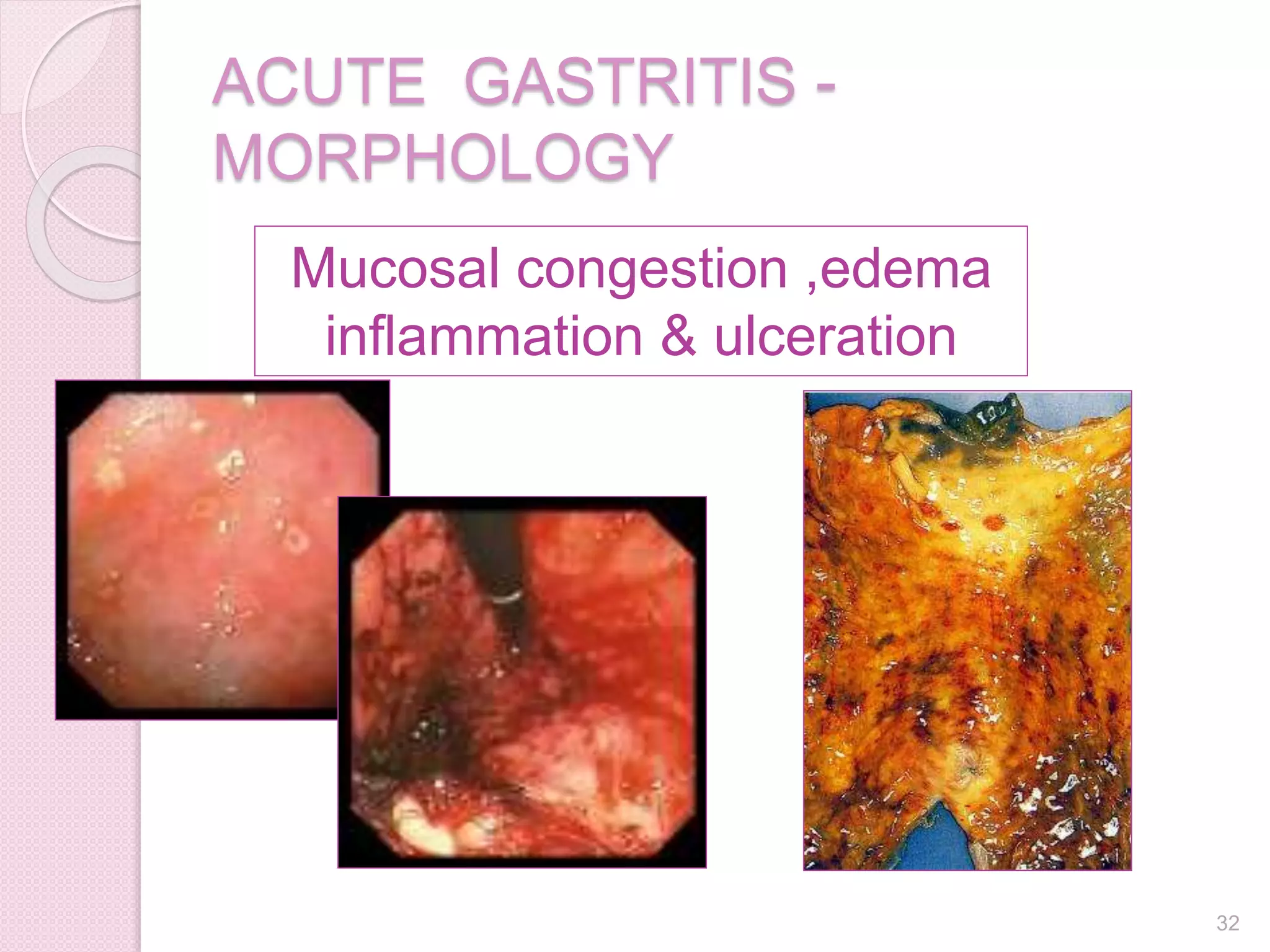 Mucosal congestion ,edema
inflammation & ulceration
ACUTE GASTRITIS -
MORPHOLOGY
32
 