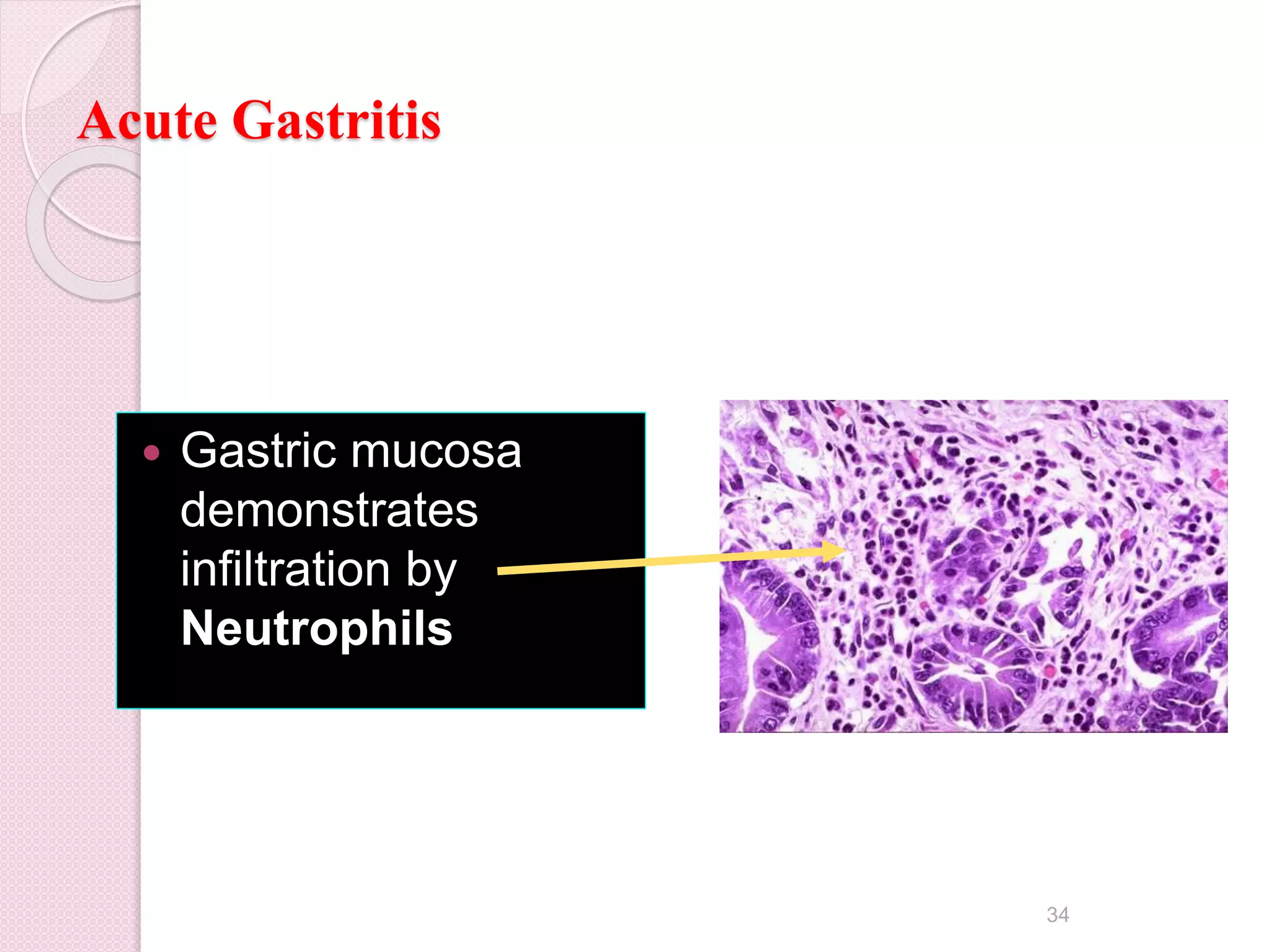 Acute Gastritis
 Gastric mucosa
demonstrates
infiltration by
Neutrophils
34
 