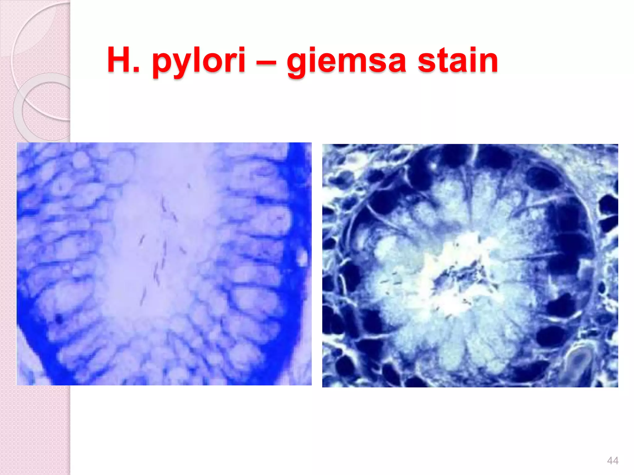 H. pylori – giemsa stain
44
 