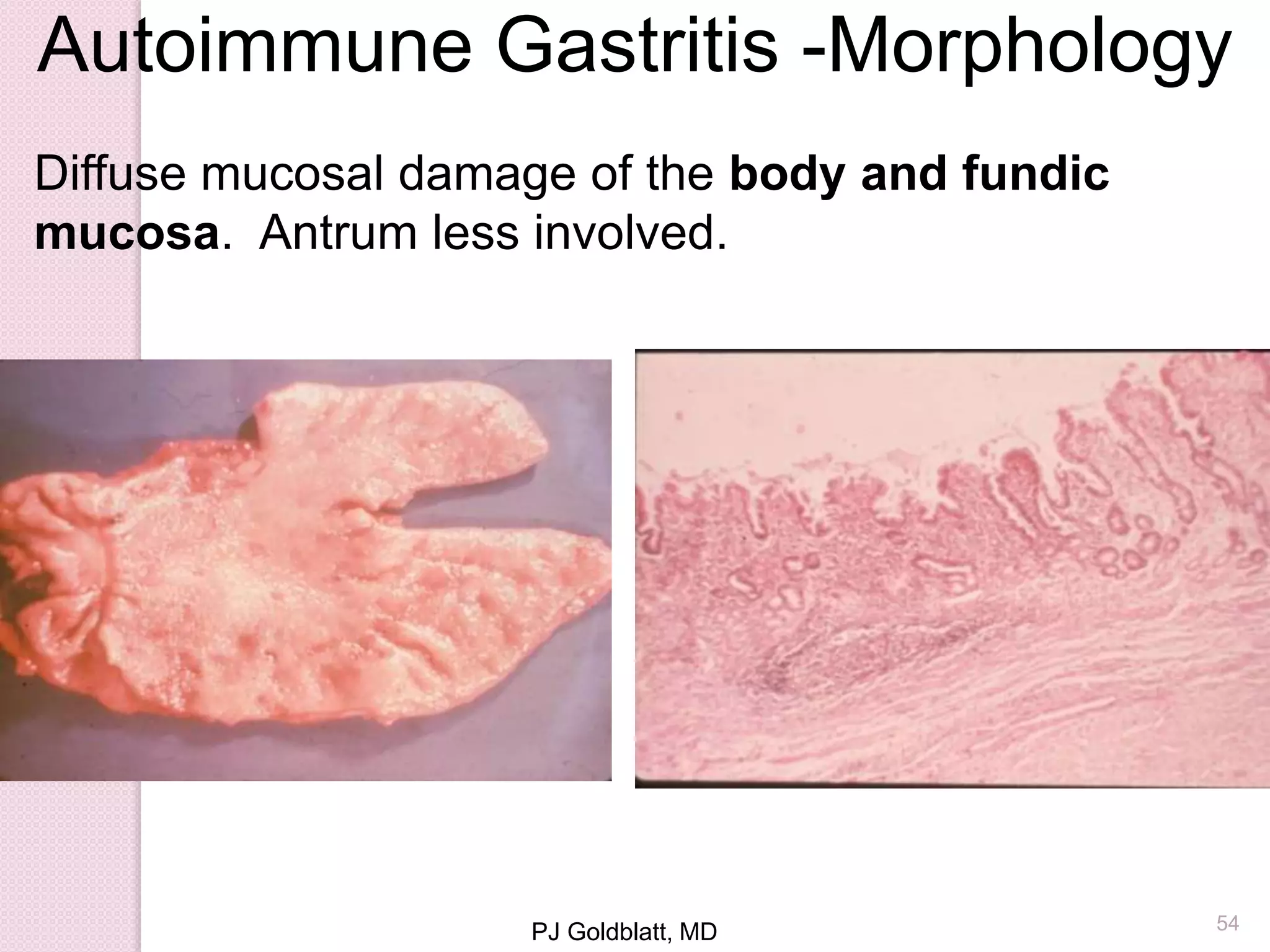 Autoimmune Gastritis -Morphology
PJ Goldblatt, MD
Diffuse mucosal damage of the body and fundic
mucosa. Antrum less involved.
54
 