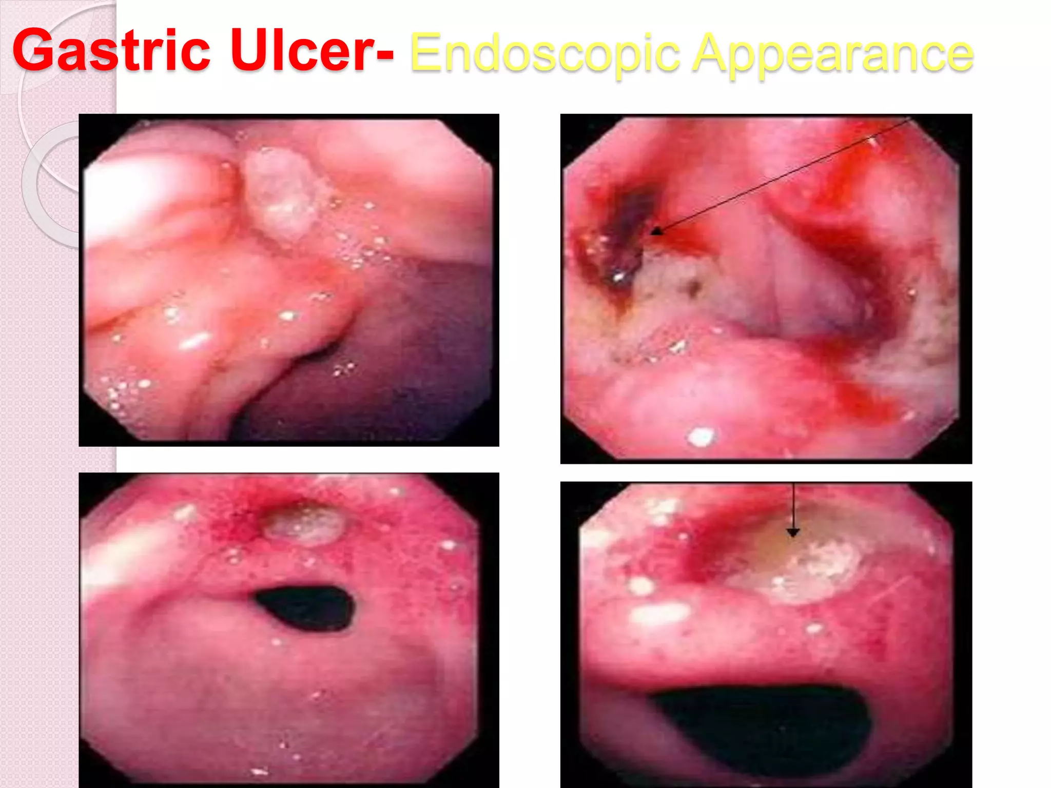 Gastric Ulcer- Endoscopic Appearance
66
 
