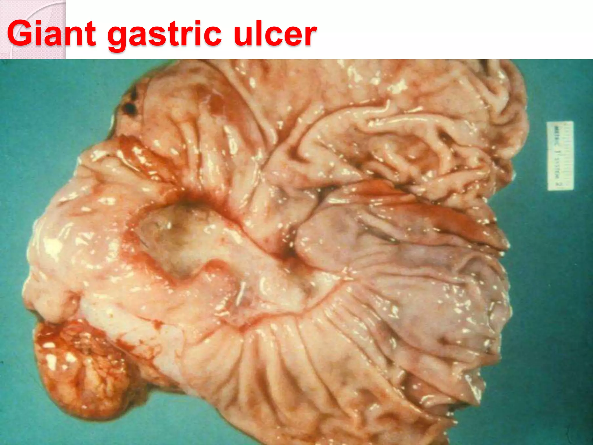 Giant gastric ulcer
69
 