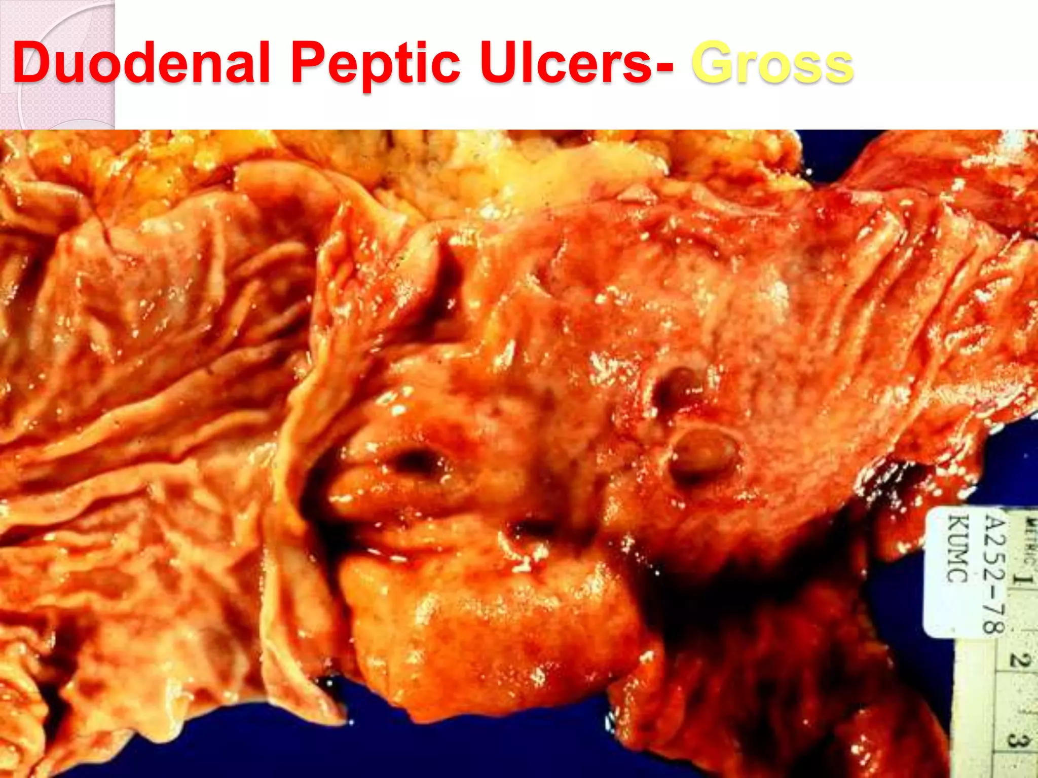 Duodenal Peptic Ulcers- Gross
70
 
