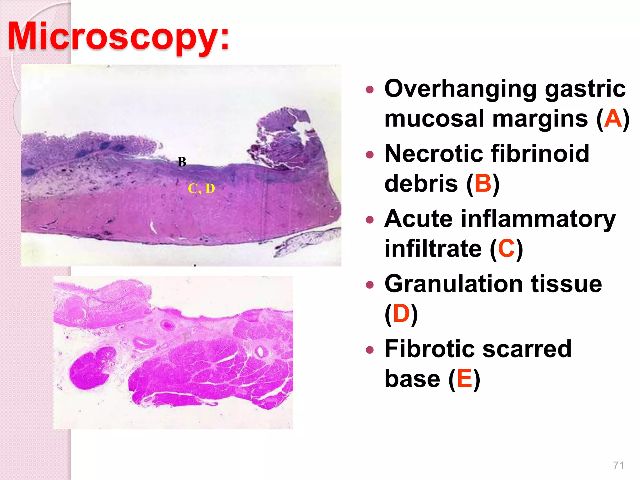 Microscopy:
 Overhanging gastric
mucosal margins (A)
 Necrotic fibrinoid
debris (B)
 Acute inflammatory
infiltrate (C)
 Granulation tissue
(D)
 Fibrotic scarred
base (E)
71
A
B
C, D
E
 