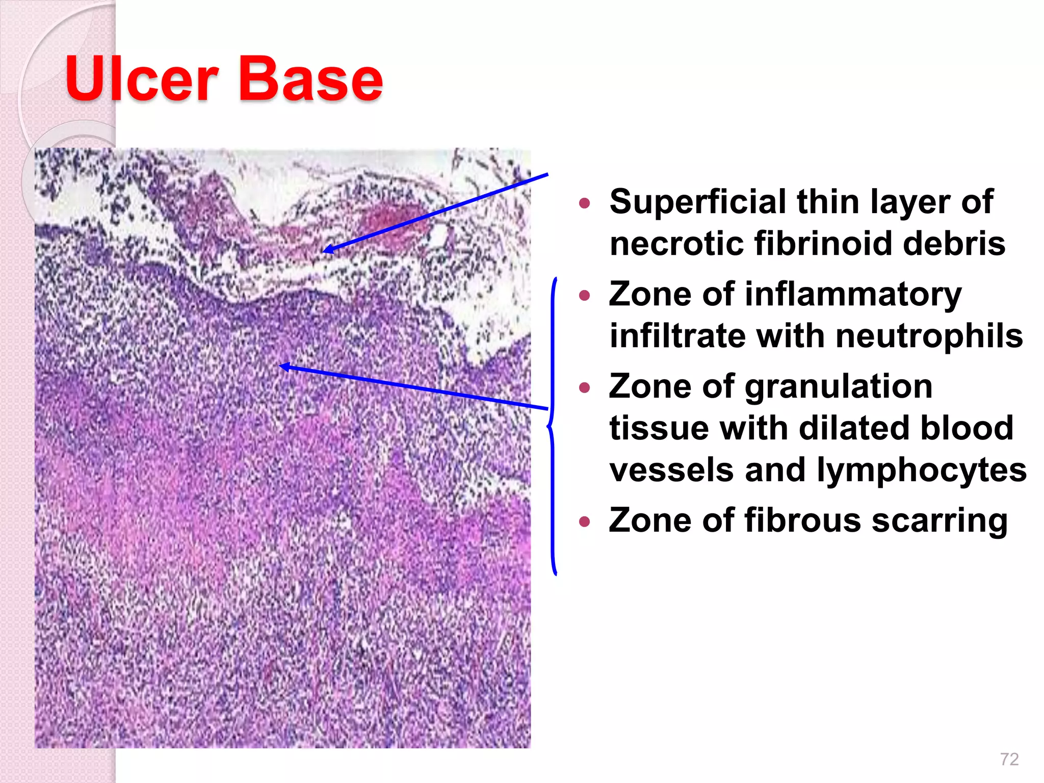 Ulcer Base
 Superficial thin layer of
necrotic fibrinoid debris
 Zone of inflammatory
infiltrate with neutrophils
 Zone of granulation
tissue with dilated blood
vessels and lymphocytes
 Zone of fibrous scarring
72
 