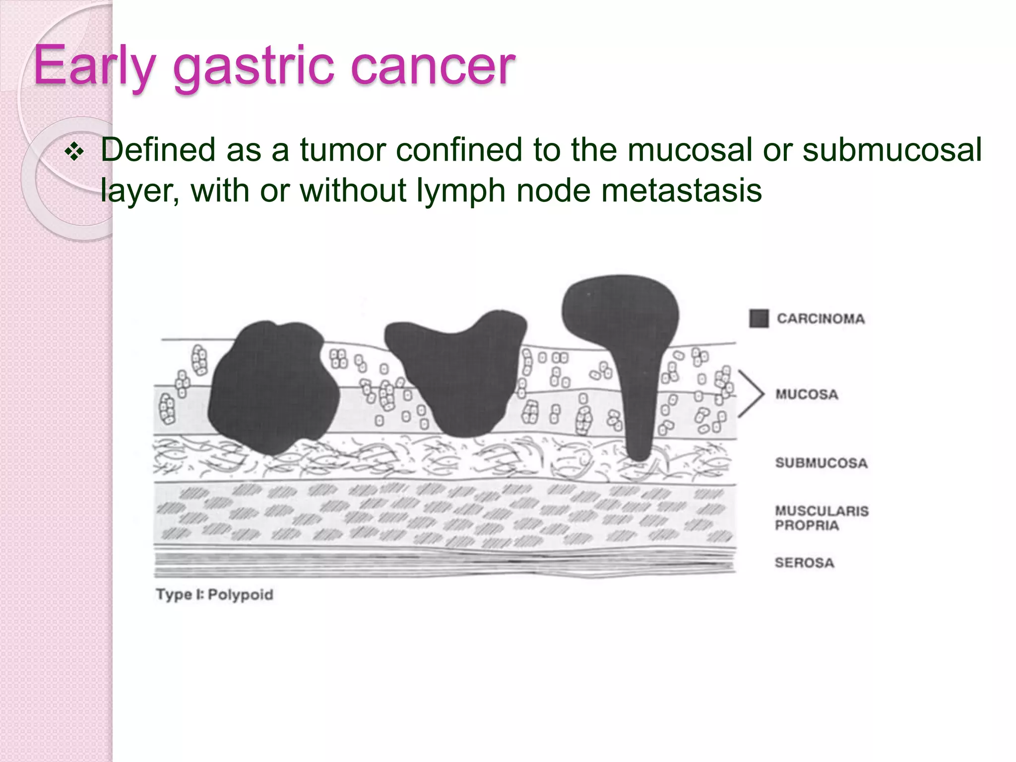 Early gastric cancer
 Defined as a tumor confined to the mucosal or submucosal
layer, with or without lymph node metastasis
 
