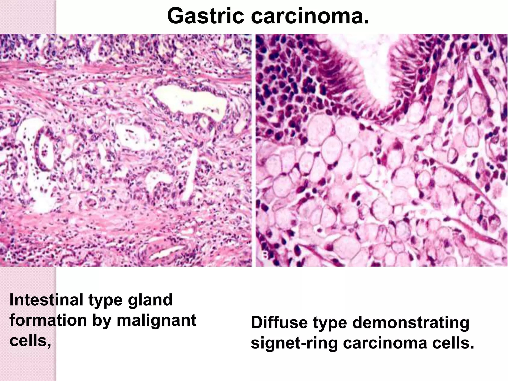 Intestinal type gland
formation by malignant
cells,
Gastric carcinoma.
Diffuse type demonstrating
signet-ring carcinoma cells.
 