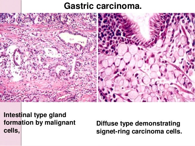 Stomach pathology lecture