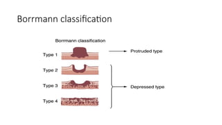 Boreman Classification Approach to carcinoma stomach and its management | PPTX