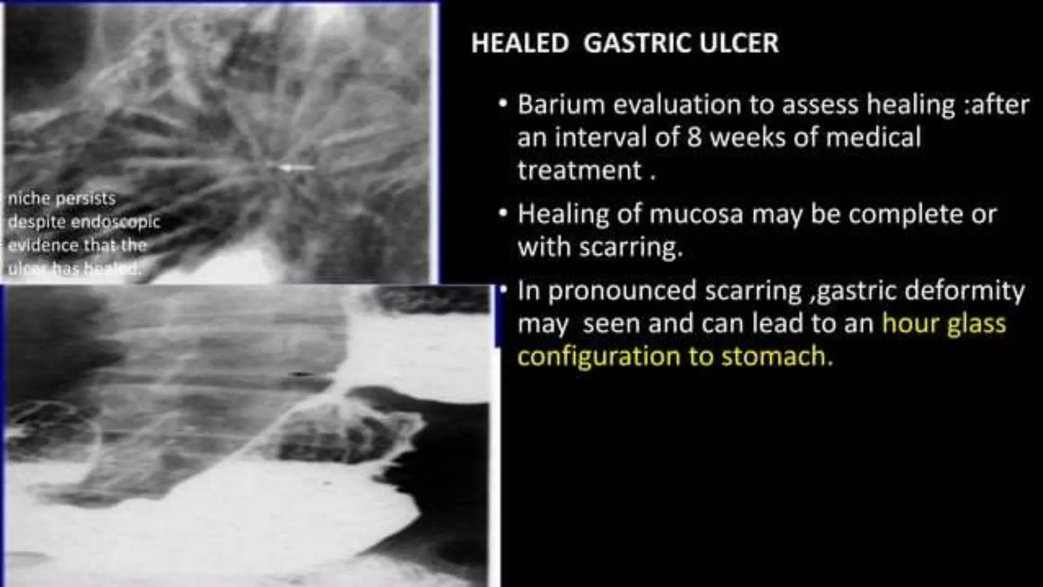 Hampton Line stomach-radiology.pptx