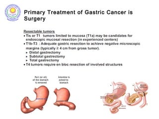 Primary Treatment of Gastric Cancer is
Surgery
 