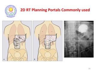 2D RT Planning Portals Commonly used
33
 