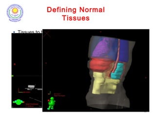 Defining Normal
Tissues
42
• Tissues to be spared need to be explicitly defined; e.g., oral
mucosa when changing from parallel-opposed to IMRT.
 