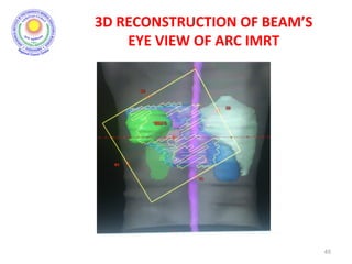 3D RECONSTRUCTION OF BEAM’S
EYE VIEW OF ARC IMRT
45
 