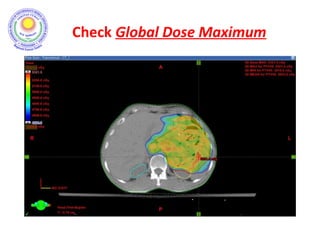 Check Global Dose Maximum
• what is its value?
– not more than 107% for 3-D CRT
– can be higher for IMRT, but within 115%
• where is it located?
– it should be within CTV
– preferably within GTV
 