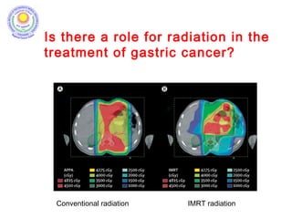 Is there a role for radiation in the
treatment of gastric cancer?
Conventional radiation IMRT radiation
 
