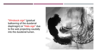 Stomach and duodenum_-_benign_lesions[2] | PPTX