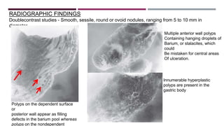 Stomach and duodenum_-_benign_lesions[2] | PPTX