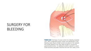 STOMACH and DUODENUM SURGERY CLASS[Autosaved].pptx