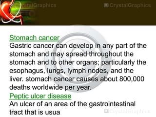 Stomach cancer
Gastric cancer can develop in any part of the
stomach and may spread throughout the
stomach and to other organs; particularly the
esophagus, lungs, lymph nodes, and the
liver. stomach cancer causes about 800,000
deaths worldwide per year.
Peptic ulcer disease
An ulcer of an area of the gastrointestinal
tract that is usua
 