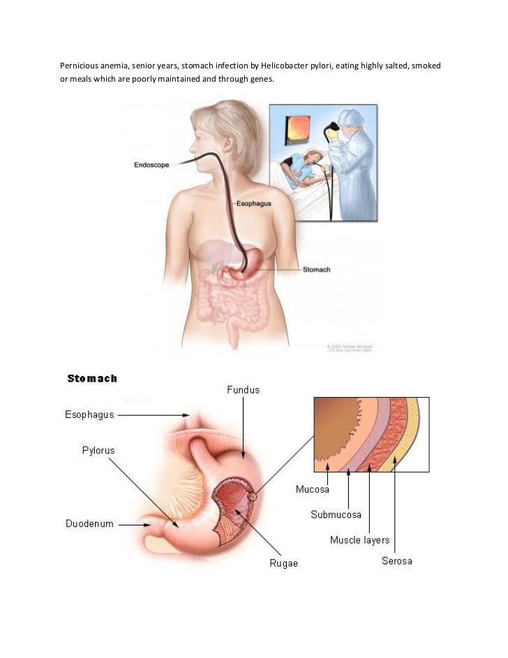 Stomach cancer symptoms
