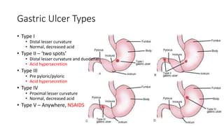Gastric Ulcer Types
• Type I
• Distal lesser curvature
• Normal, decreased acid
• Type II – ‘two spots’
• Distal lesser curvature and duodenal
• Acid hypersecretion
• Type III
• Pre pyloric/pyloric
• Acid hypersecretion
• Type IV
• Proximal lesser curvature
• Normal, decreased acid
• Type V – Anywhere, NSAIDS
 