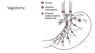 Vagotomy
 