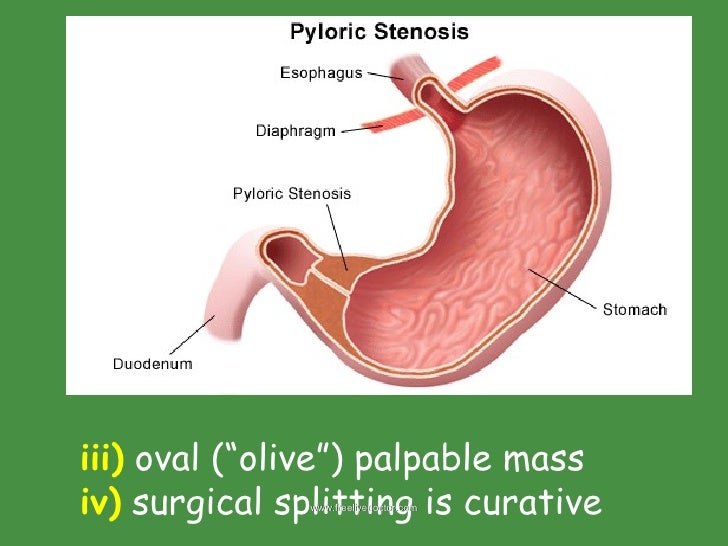 pyloric stenosis Read medical definition of pyloric stenosis pyloric stenosis: narrowing (stenosis) of the outlet of the stomach so that food cannot pass easily from it into the duodenum pyloric stenosis results in feeding problems and projectile vomiting in infa. pyloric stenosis Read medical definition of pyloric stenosis pyloric stenosis: narrowing (stenosis) of the outlet of the stomach so that food cannot pass easily from it into the duodenum pyloric stenosis results in feeding problems and projectile vomiting in infa.