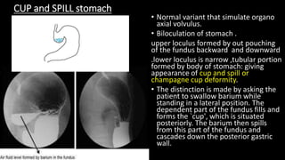 CUP and SPILL stomach
• Normal variant that simulate organo
axial volvulus.
• Biloculation of stomach .
upper loculus formed by out pouching
of the fundus backward and downward
.lower loculus is narrow ,tubular portion
formed by body of stomach: giving
appearance of cup and spill or
champagne cup deformity.
• The distinction is made by asking the
patient to swallow barium while
standing in a lateral position. The
dependent part of the fundus fills and
forms the `cup', which is situated
posteriorly. The barium then spills
from this part of the fundus and
cascades down the posterior gastric
wall.
 