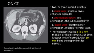ON CT
• two- or three-layered structure
1. inner layer : mucosal layer,
enhances markedly.
2. intermediate layer : low
attenuation , the submucosal layer.
3. outer layer : slightly higher
attenuation , muscular-serosal layer.
• normal gastric wall is 2 to 5 mm
thick (in air-filled stomach, 3or 5mm
is upper limit of normal), with 10
mm being the upper limit for
normal.
Normal gastric wall of the stomach (S) with layered
appearance
 