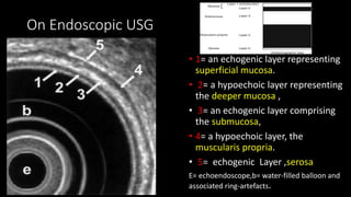 On Endoscopic USG
• 1= an echogenic layer representing
superficial mucosa.
• 2= a hypoechoic layer representing
the deeper mucosa ,
• 3= an echogenic layer comprising
the submucosa,
• 4= a hypoechoic layer, the
muscularis propria.
• 5= echogenic Layer ,serosa
E= echoendoscope,b= water-filled balloon and
associated ring-artefacts.
 