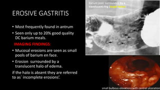 EROSIVE GASTRITIS
• Most frequently found in antrum
• Seen only up to 20% good quality
DC barium meals.
IMAGING FINDINGS:
• Mucosal erosions are seen as small
pools of barium en face.
• Erosion surrounded by a
translucent halo of edema.
if the halo is absent they are referred
to as` incomplete erosions’.
Barium pool surrounded by a
translucent ring (target lesion)
small bulbous elevations with central ulcerations
 