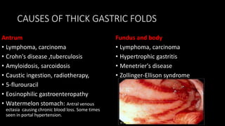 CAUSES OF THICK GASTRIC FOLDS
Antrum
• Lymphoma, carcinoma
• Crohn's disease ,tuberculosis
• Amyloidosis, sarcoidosis
• Caustic ingestion, radiotherapy,
• 5-flurouracil
• Eosinophilic gastroenteropathy
• Watermelon stomach: Antral venous
ectasia causing chronic blood loss. Some times
seen in portal hypertension.
Fundus and body
• Lymphoma, carcinoma
• Hypertrophic gastritis
• Menetrier's disease
• Zollinger-Ellison syndrome
 