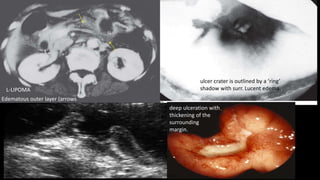 Thin regular radiating folds are converging
to the ulcer
ulcer crater is outlined by a ‘ring’
shadow with surr. Lucent edema..
deep ulceration with
thickening of the
surrounding
margin.
u
L-LIPOMA
Edematous outer layer (arrows
L
 