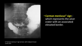 • Carman meniscus” sign :
which represents the ulcer
crater with an associated
elevated border.
b “Carman meniscus” sign (arrow) with malignant lesser
curve ulcer
 