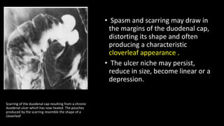 • Spasm and scarring may draw in
the margins of the duodenal cap,
distorting its shape and often
producing a characteristic
cloverleaf appearance .
• The ulcer niche may persist,
reduce in size, become linear or a
depression.
Scarring of the duodenal cap resulting from a chronic
duodenal ulcer which has now healed. The pouches
produced by the scarring resemble the shape of a
cloverleaf
 