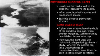 • usually on the medial wall of the
duodenal loop above the papilla.
• often associated with edema and
pronounced spasm .
• Scarring produce permanent
stricture
GIANT ULCER OF D.CAP
• A giant ulcer may replace the whole
of the duodenal cap, and, when
smooth margined, such ulcers may
be mistaken for a normal cap.
• However, the giant ulcer will
maintain its shape during a barium
Study , whereas the normal cap,
(also Outpouchings or
pseudodiverticula) can at times be
seen to contract with peristalsis.
ulcer crater (asterisk) in the middle of a stricture
produced by spasm and edema. POST BULBAR DUODENAL ULCER
 