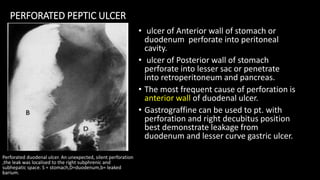 PERFORATED PEPTIC ULCER
• ulcer of Anterior wall of stomach or
duodenum perforate into peritoneal
cavity.
• ulcer of Posterior wall of stomach
perforate into lesser sac or penetrate
into retroperitoneum and pancreas.
• The most frequent cause of perforation is
anterior wall of duodenal ulcer.
• Gastrograffine can be used to pt. with
perforation and right decubitus position
best demonstrate leakage from
duodenum and lesser curve gastric ulcer.
Perforated duodenal ulcer. An unexpected, silent perforation
,the leak was localised to the right subphrenic and
subhepatic space. S = stomach,D=duodenum,b= leaked
barium.
 