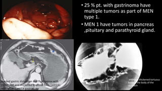 • 25 % pt. with gastrinoma have
multiple tumors as part of MEN
type 1.
• MEN 1 have tumors in pancreas
,pituitary and parathyroid gland.
enlarged thickened tortuous
folds in the body of the
stomach
marked gastric distention and fluid excess with
prominent and thickened mucosal folds (astrick)
with small mass i.e gastrinoma
 