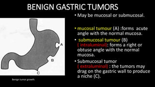 BENIGN GASTRIC TUMORS
• May be mucosal or submucosal.
• mucosal tumour (A) :forms acute
angle with the normal mucosa.
• submucosal tumour (B)
( intraluminal): forms a right or
obtuse angle with the normal
mucosa.
• Submucosal tumor
( extraluminal) : the tumors may
drag on the gastric wall to produce
a niche (C).
Benign tumor growth.
 