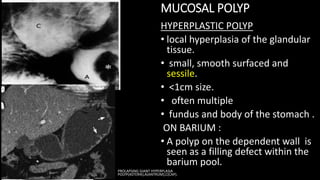 MUCOSAL POLYP
HYPERPLASTIC POLYP
• local hyperplasia of the glandular
tissue.
• small, smooth surfaced and
sessile.
• <1cm size.
• often multiple
• fundus and body of the stomach .
ON BARIUM :
• A polyp on the dependent wall is
seen as a filling defect within the
barium pool.
PROLAPSING GIANT HYPERPLASIA
POLYP(ASTERIK),A(ANTRUM),C(CAP).
 