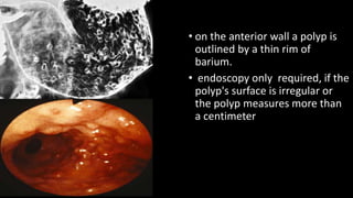 • on the anterior wall a polyp is
outlined by a thin rim of
barium.
• endoscopy only required, if the
polyp's surface is irregular or
the polyp measures more than
a centimeter
).
 
