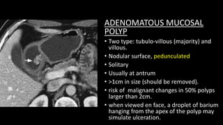 ADENOMATOUS MUCOSAL
POLYP
• Two type: tubulo-villous (majority) and
villous.
• Nodular surface, pedunculated
• Solitary
• Usually at antrum
• >1cm in size (should be removed).
• risk of malignant changes in 50% polyps
larger than 2cm.
• when viewed en face, a droplet of barium
hanging from the apex of the polyp may
simulate ulceration.
 