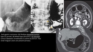 Early gastric carcinoma. (A) Shallow ulcerating tumour,
type 2C (arrow). (B) Mixed type (2B and C). An elevated
tumour (between arrowheads) is outline by barium. Two
small irregular ulcers are present (arrows).
2c
2B
2C
 