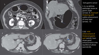 1. A, no definite
pathologic lesion at
gastric angle
(arrow). B, Focal wall
thickening with
subtle enhancement
of inner layer
(arrow) . IIa.
1. 1.
2.(A) mild
enhancement of
thickened gastric
wall (astrck). Scan
shows good
enhancement in the
equilibrium phase
(astrick) (B).
Early gastric cancer
2
.
2.
 