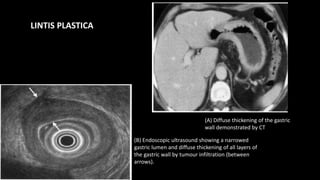 (B) Endoscopic ultrasound showing a narrowed
gastric lumen and diffuse thickening of all layers of
the gastric wall by tumour infiltration (between
arrows).
(A) Diffuse thickening of the gastric
wall demonstrated by CT
LINTIS PLASTICA
 