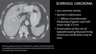 Scirrhous adenocarcinoma of the stomach. gastric wall thickening with
a markedly enhanced submucosal layer and a poorly enhanced thin rim
of mucosal layer. Ascites also seen
SCIRRHOUS CARCINOMA
• Less common variety
• Spread in submucosa.
• CT: diffuse circumferential
thickening of gastric wall with
mean range 1-3 cm.
• Preservation of thin rim of
hypoattenuating Mucosal lining
intramural calcification may be
seen
 
