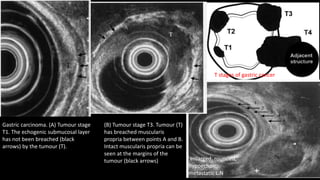 T stages of gastric cancer
enlarged, rounded,
hypoechoic,
metastatic L.N
Gastric carcinoma. (A) Tumour stage
T1. The echogenic submucosal layer
has not been breached (black
arrows) by the tumour (T).
(B) Tumour stage T3. Tumour (T)
has breached muscularis
propria between points A and B.
Intact muscularis propria can be
seen at the margins of the
tumour (black arrows)
 
